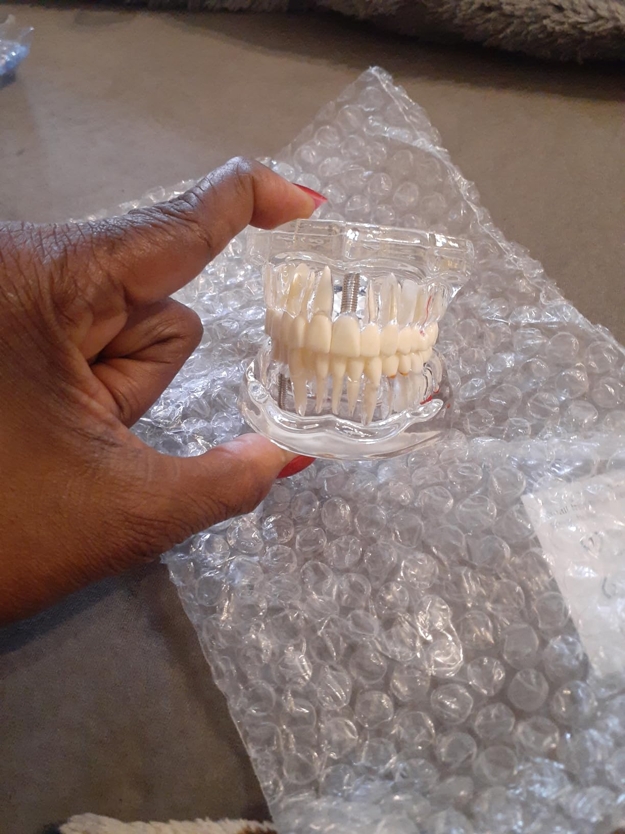 Ultrassist Transparent Dental Disease Teeth Model with Removable Teeth | Dental Pathology Demonstration Model for Dentist Patient Education & Teaching customer photo 1