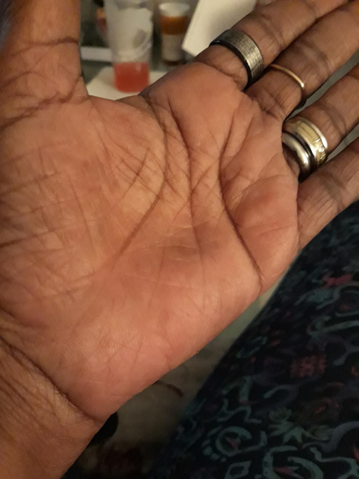 Callus Repair Hand Care Treatment Salve By WOD Welder - For Fitness Athletes, Gymnastics, Weightlifters, and Rock Climbing - Heals Rips and Tears, No Shaver Speeds Recovery - Smells Great, All Natural customer photo 1