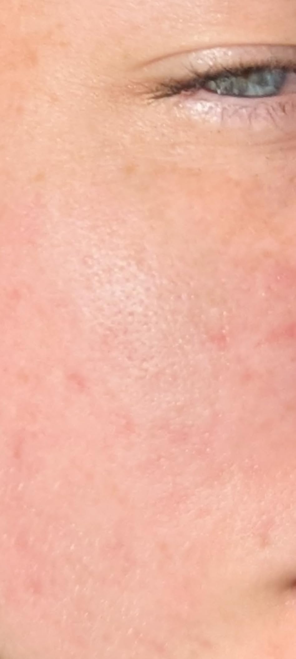 CeraVe Foaming Acne Cream Cleanser, Face Wash with 4% Benzoyl Peroxide, 5oz customer photo 1