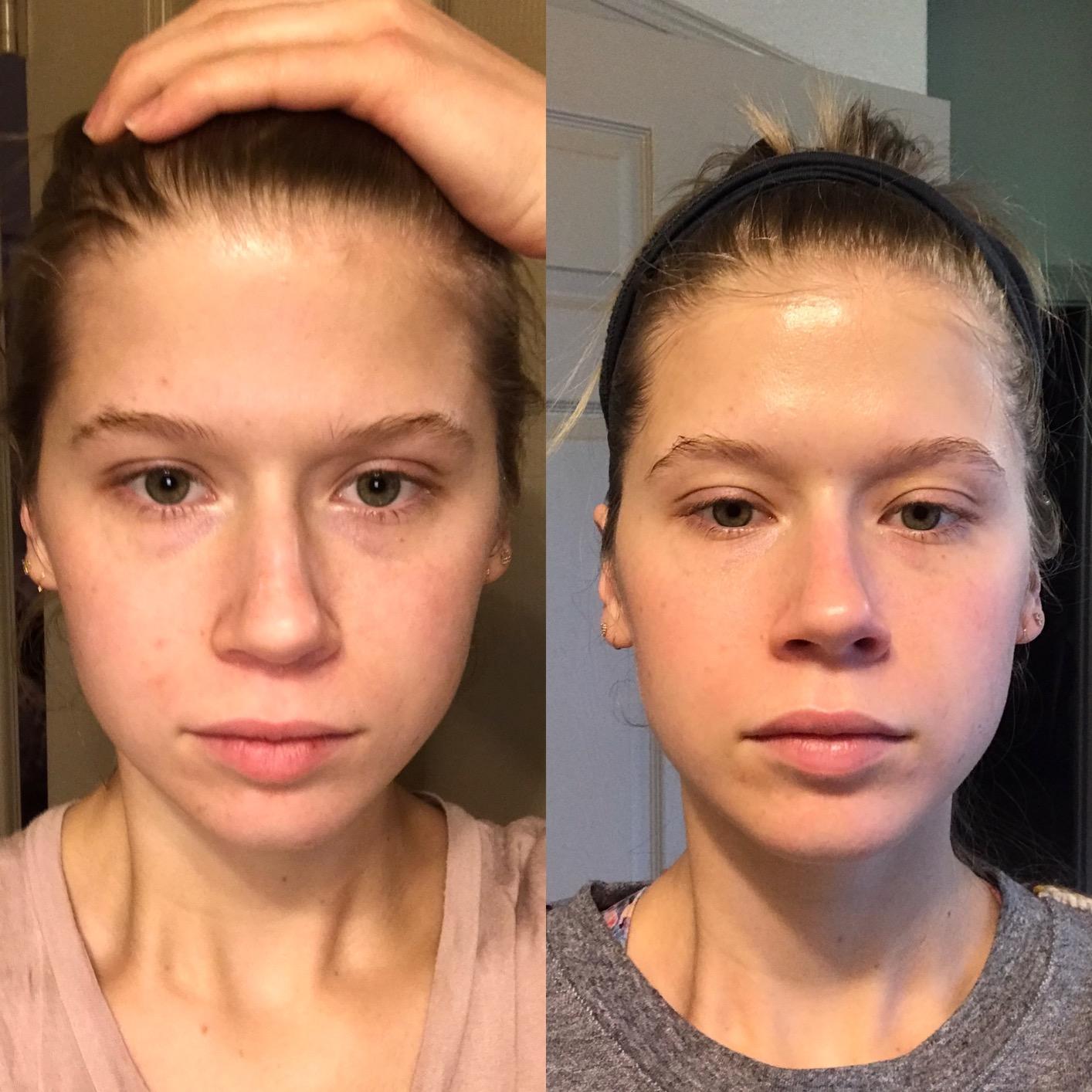 The Ordinary The Daily Set, Daily Skincare Routine with Squalane Cleanser, Hyaluronic Acid 2% + B5, and Natural Moisturizing Factors + HA | Skin Care Set customer photo 1