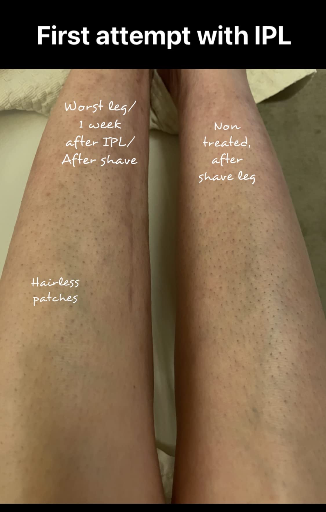 Braun IPL, Silk·Expert Pro 5, IPL Hair Removal for Women and Men, Permanent Laser Hair Reduction At-Home, 2 Heads, Pouch, Venus Razor, IPL5157 customer photo 1